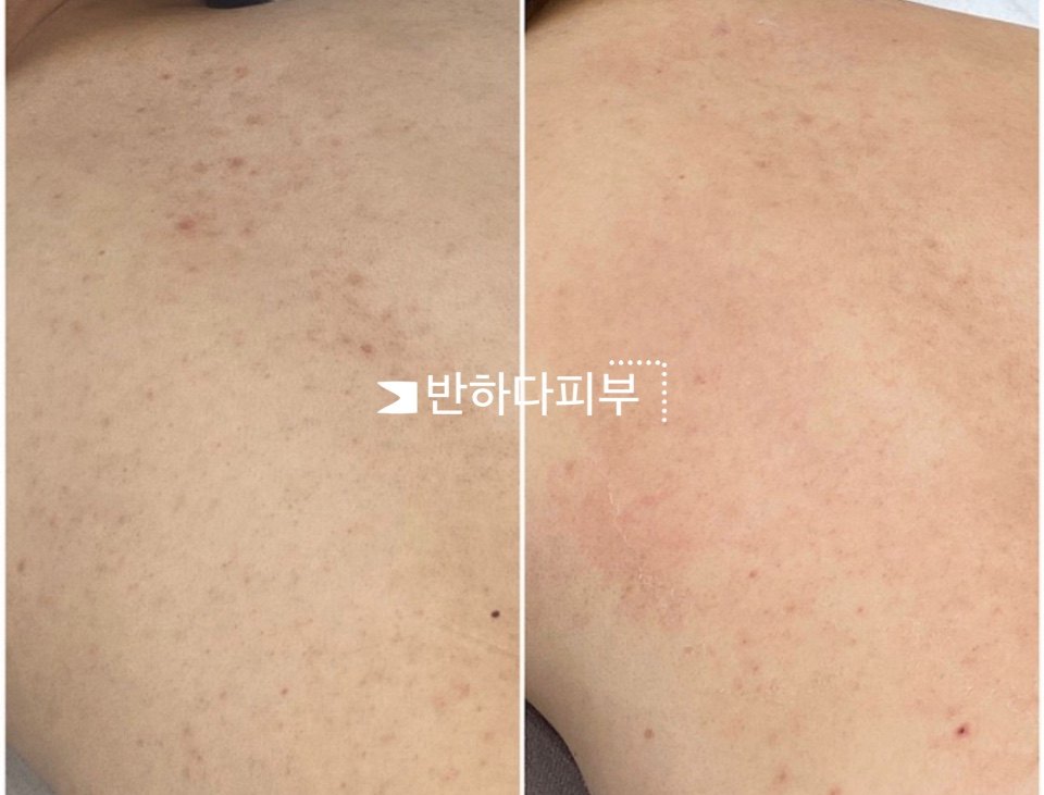 등 피부 관리 전과 후