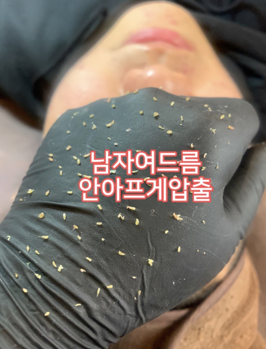 남성 여드름 관리 중 얹은 모델링 마스크
